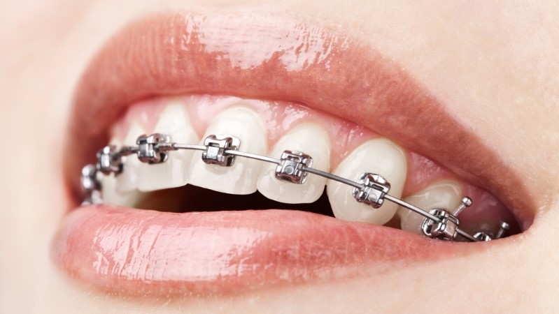 How Do Braces Work – The Advance Information Of Using Braces In 2021