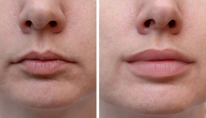 How To Get A Natural Lip Filler Look