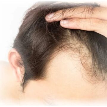 Hair Transplant In London
